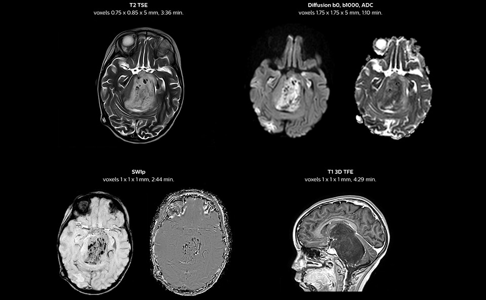 MRI of pediatric brainstem glioma