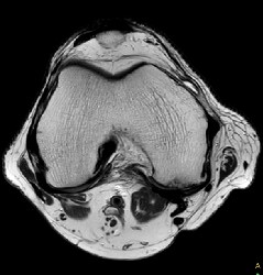PHH conventional acceleration spine imaging