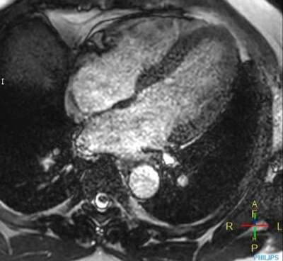 PHH conventional acceleration cardiac imaging
