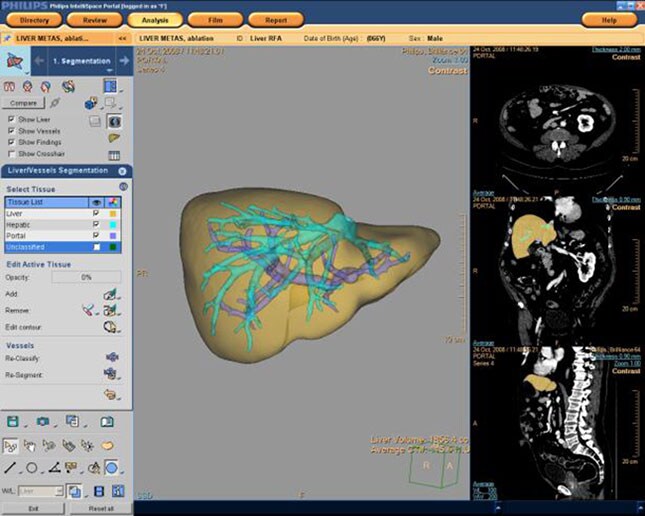 liver analysis LM